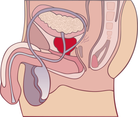 Possible Link Found Between Prostate Cancer and STI